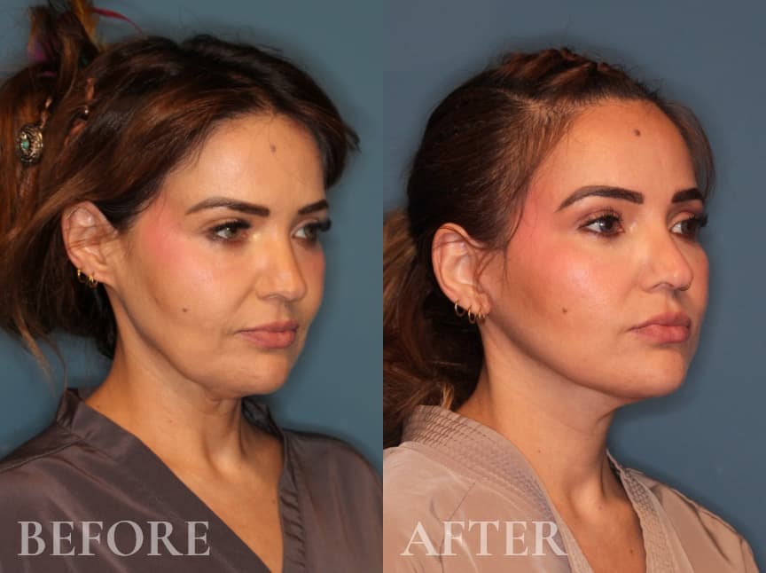 Before and After Face & Neck Lift