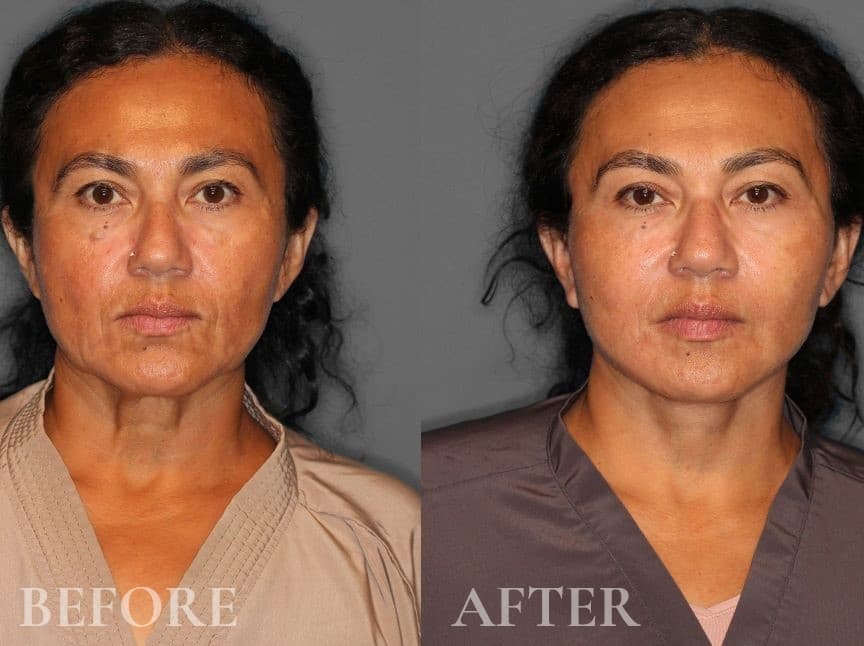 Before and After Face & Neck Lift