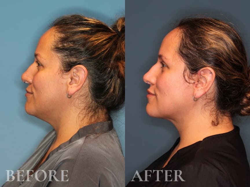 Before and After Neck Liposuction