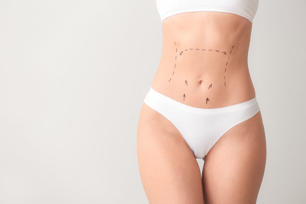Patient receiving pre-surgical markings for tummy tuck procedure (model)
