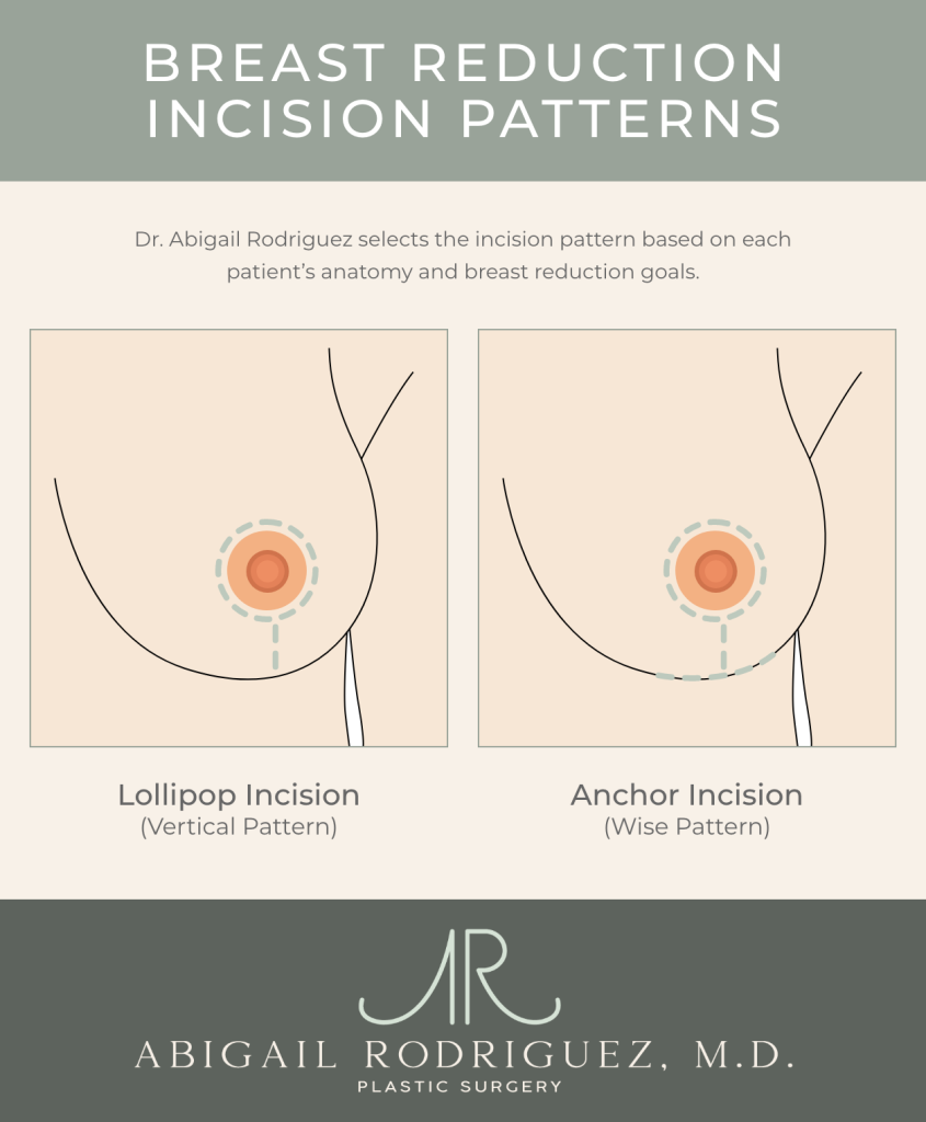 Diagram comparing lollipop and anchor breast reduction incisions, showing scar placement around and below the areola.