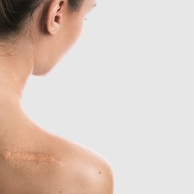 young womans back with a scar