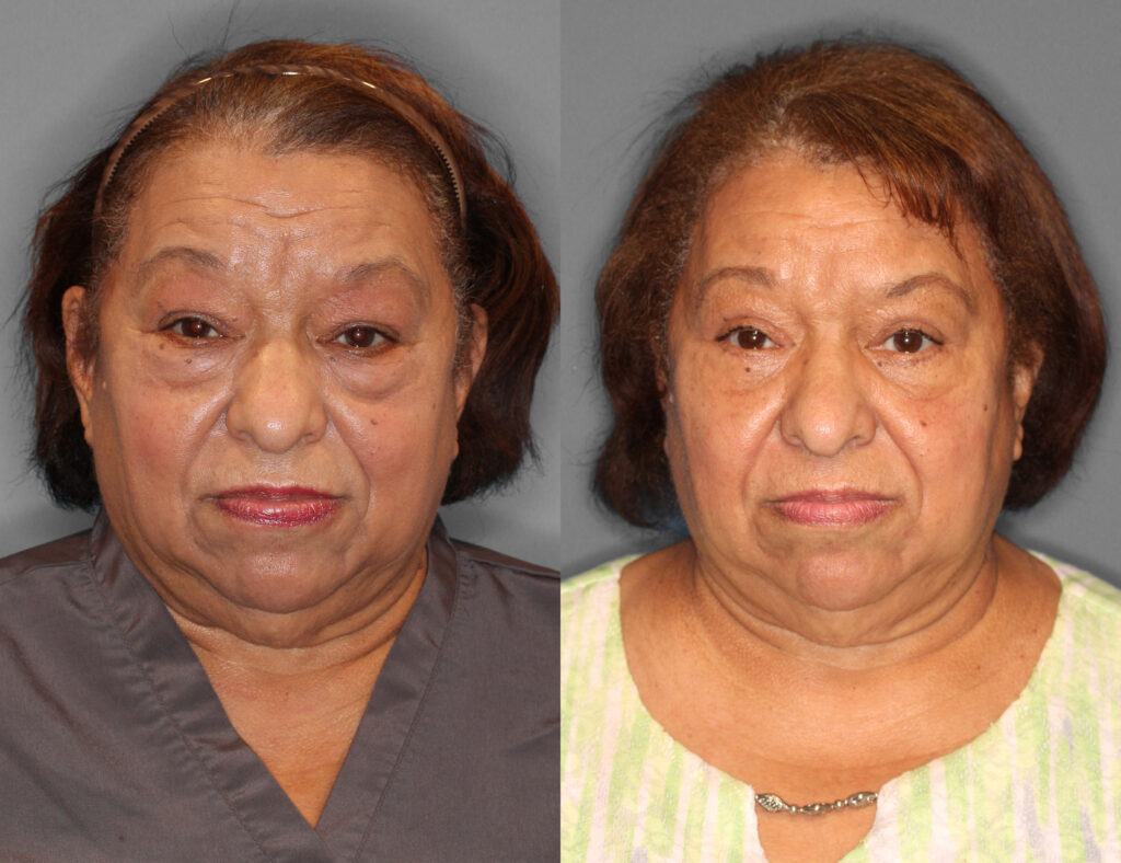 Eyelid Lift Before and After photo by Dr. Abigail Rodriguez in Houston, TX
