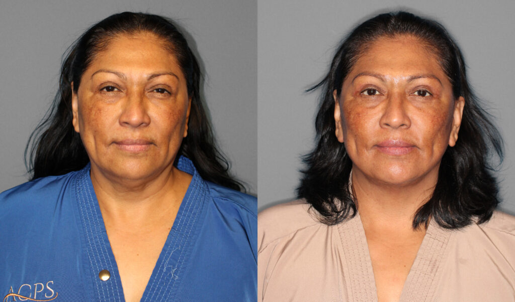Face & Neck Lift, Eyelid Lift Before and After photo by Dr. Abigail Rodriguez in Houston, TX