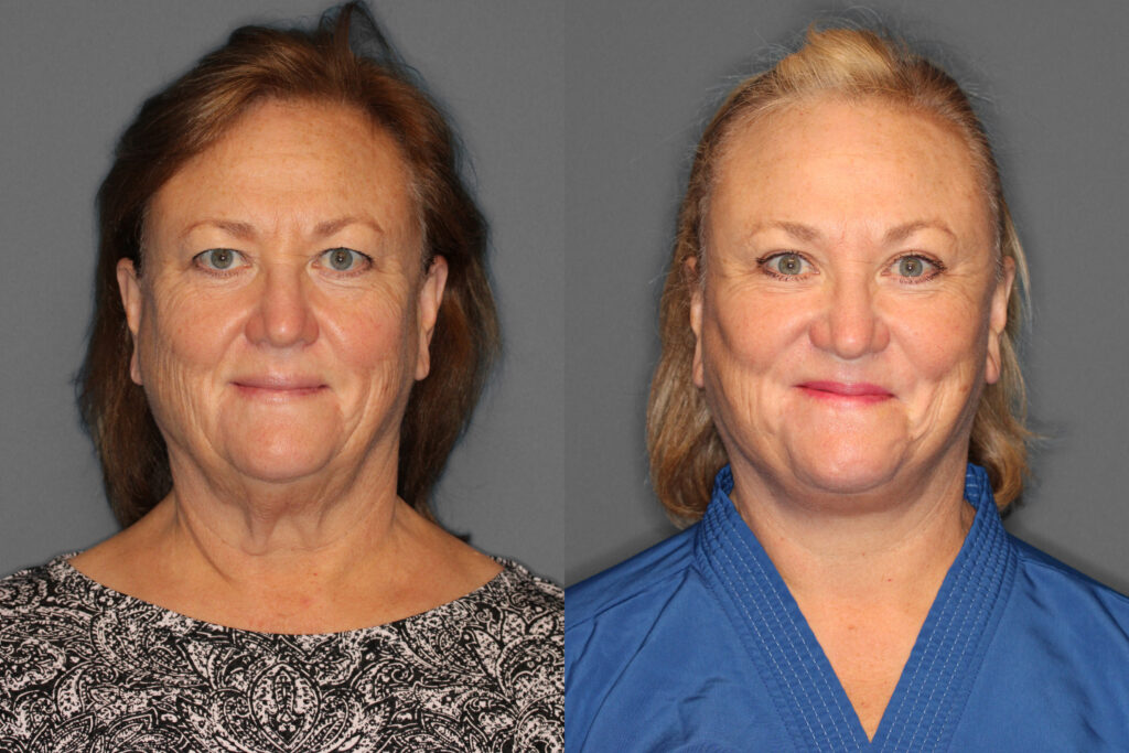 Face & Neck Lift, Eyelid Lift Before and After photo by Dr. Abigail Rodriguez in Houston, TX