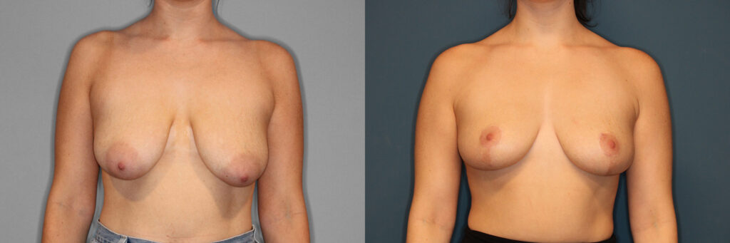 Breast Reduction Before and After photo by Dr. Abigail Rodriguez in Houston, TX