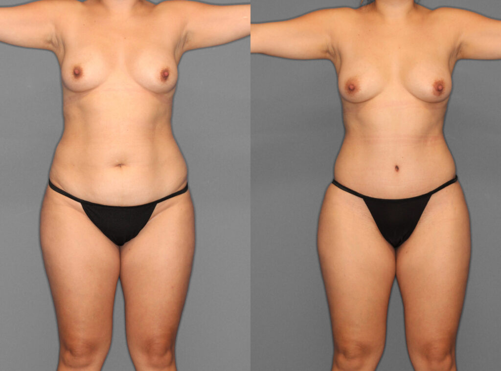 Liposuction:Tummy Tuck Before and After photo by Dr. Abigail Rodriguez in Houston, TX