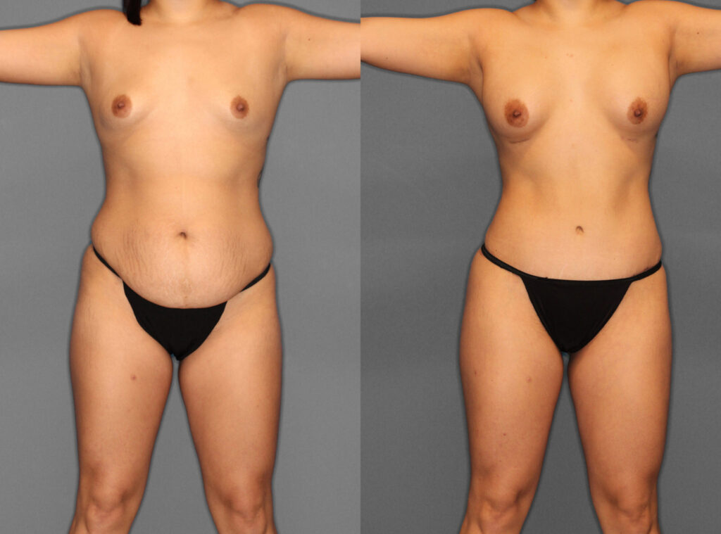 Liposuction:Tummy Tuck Before and After photo by Dr. Abigail Rodriguez in Houston, TX