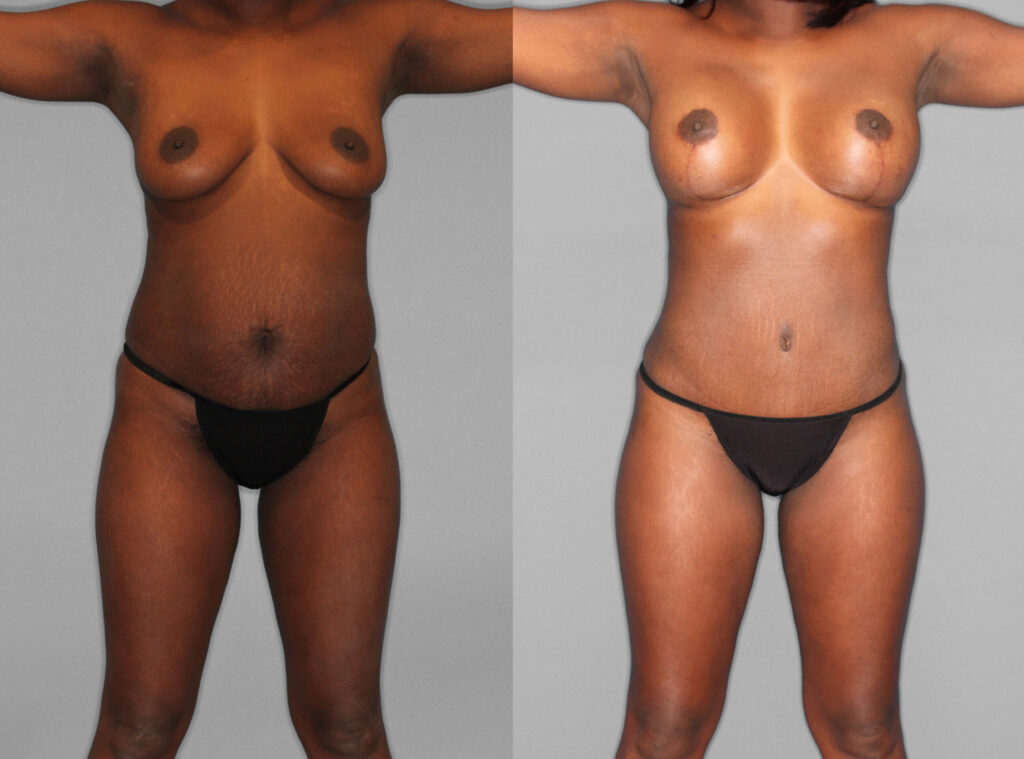 Liposuction:Tummy Tuck:Fat Grafting Before and After photo by Dr. Abigail Rodriguez in Houston, TX