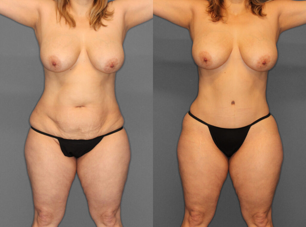 Tummy Tuck Liposuction Before and After photo by Dr. Abigail Rodriguez in Houston, TX