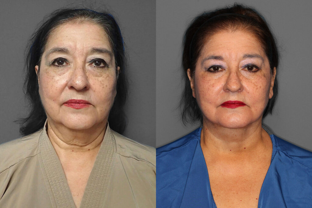 Face/Neck Lift + Lower Blepharoplasty Before and After photo by Dr. Abigail Rodriguez in Houston, TX