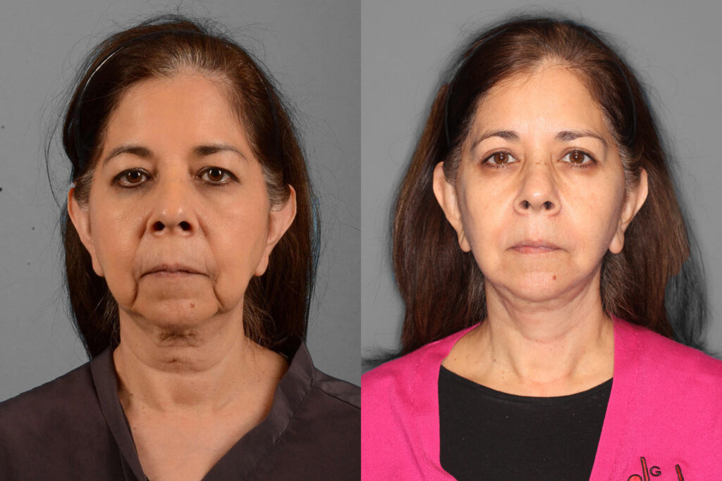 Face/Neck Lift + Buccal Fat + Upper Blepharoplasty Before and After photo by Dr. Abigail Rodriguez in Houston, TX