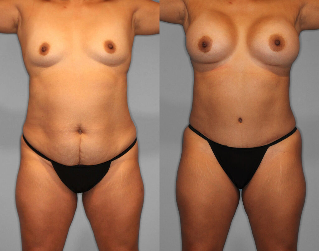 Tummy Tuck + Liposuction Before and After photo by Dr. Abigail Rodriguez in Houston, TX