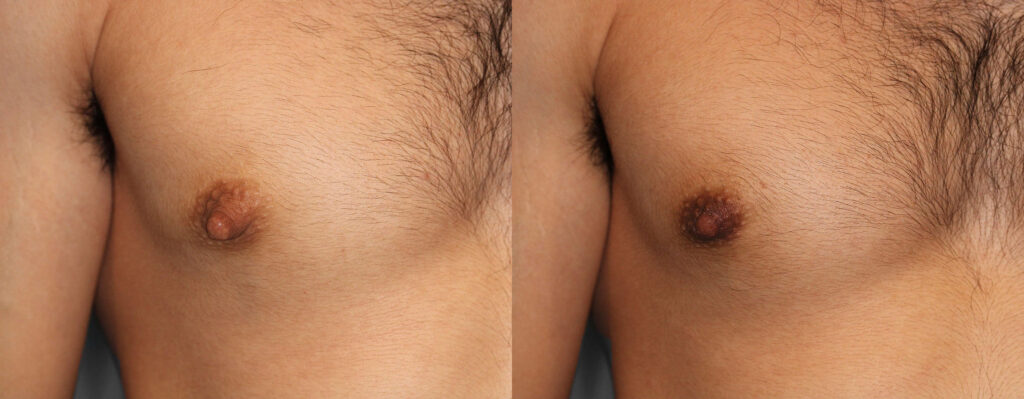 Nipple Reduction Before and After photo by Dr. Abigail Rodriguez in Houston, TX