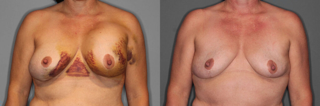 Implant Removal Before and After photo by Dr. Abigail Rodriguez in Houston, TX