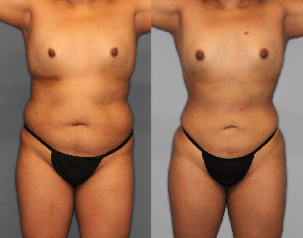 Lipo & BBL Before and After photo by Dr. Abigail Rodriguez in Houston, TX
