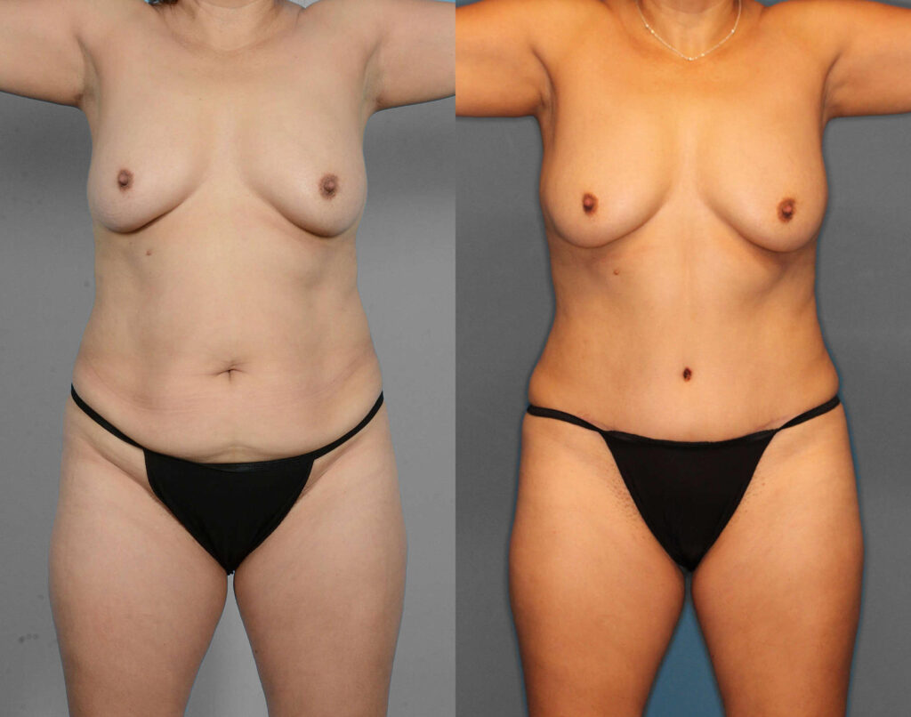 Tummy Tuck Before and After photo by Dr. Abigail Rodriguez in Houston, TX