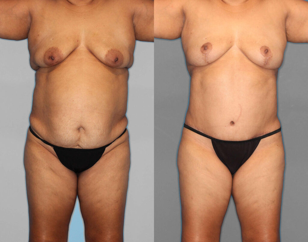 Tummy Tuck:Lipo:Hernia Repair Before and After photo by Dr. Abigail Rodriguez in Houston, TX