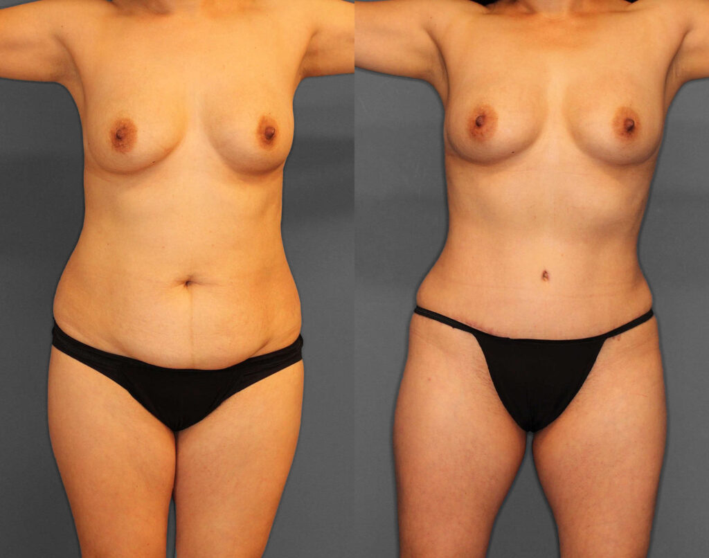 Liposuction:Tummy Tuck Before and After photo by Dr. Abigail Rodriguez in Houston, TX