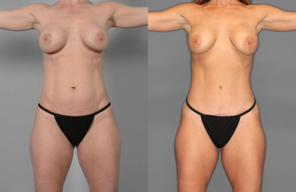 Tummy Tuck Before and After photo by Dr. Abigail Rodriguez in Houston, TX