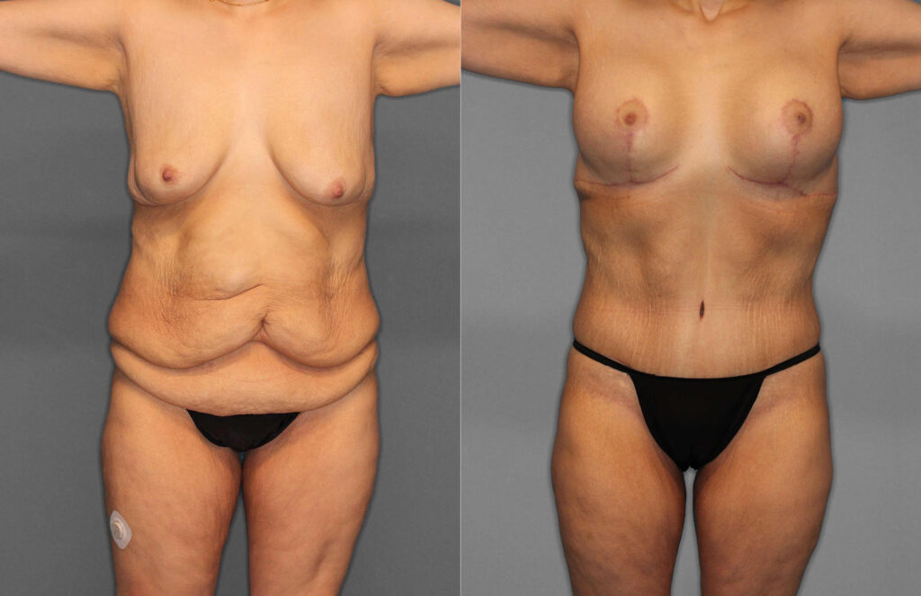 Tummy Tuck Before and After photo by Dr. Abigail Rodriguez in Houston, TX