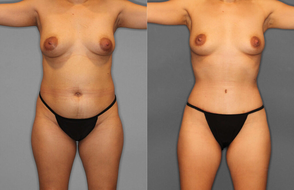 Tummy Tuck:Liposuction Before and After photo by Dr. Abigail Rodriguez in Houston, TX