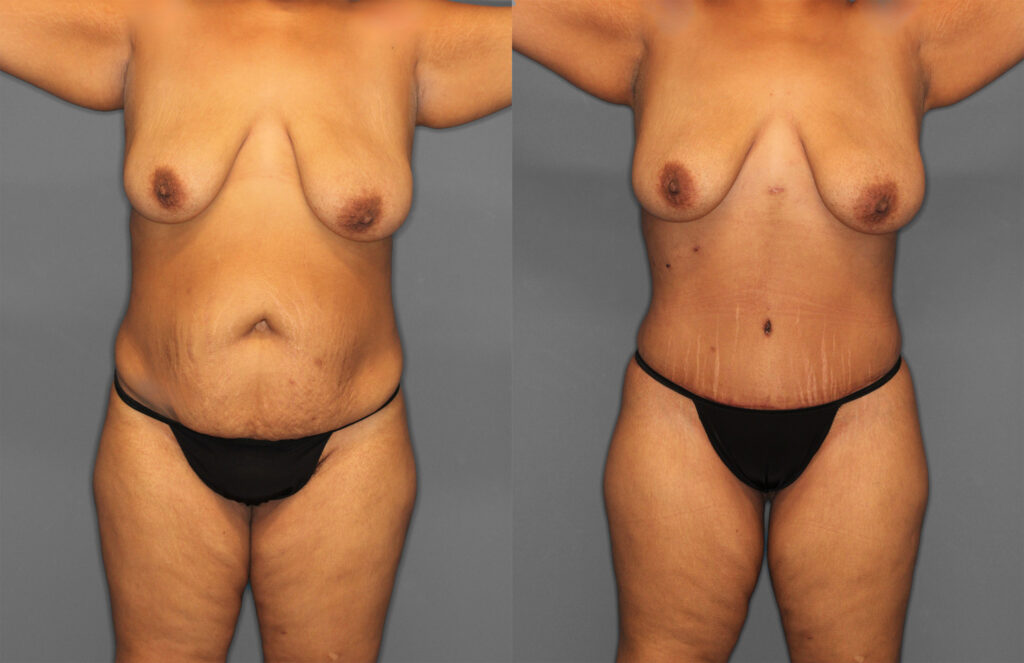 Tummy Tuck:Liposuction Before and After photo by Dr. Abigail Rodriguez in Houston, TX