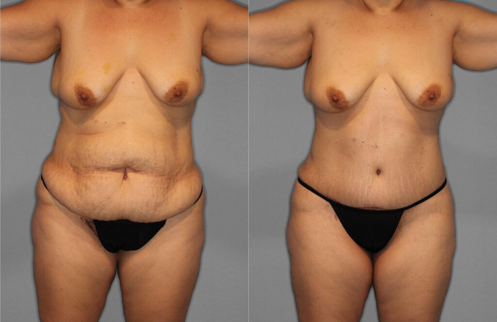 Tummy Tuck:Liposuction Before and After photo by Dr. Abigail Rodriguez in Houston, TX