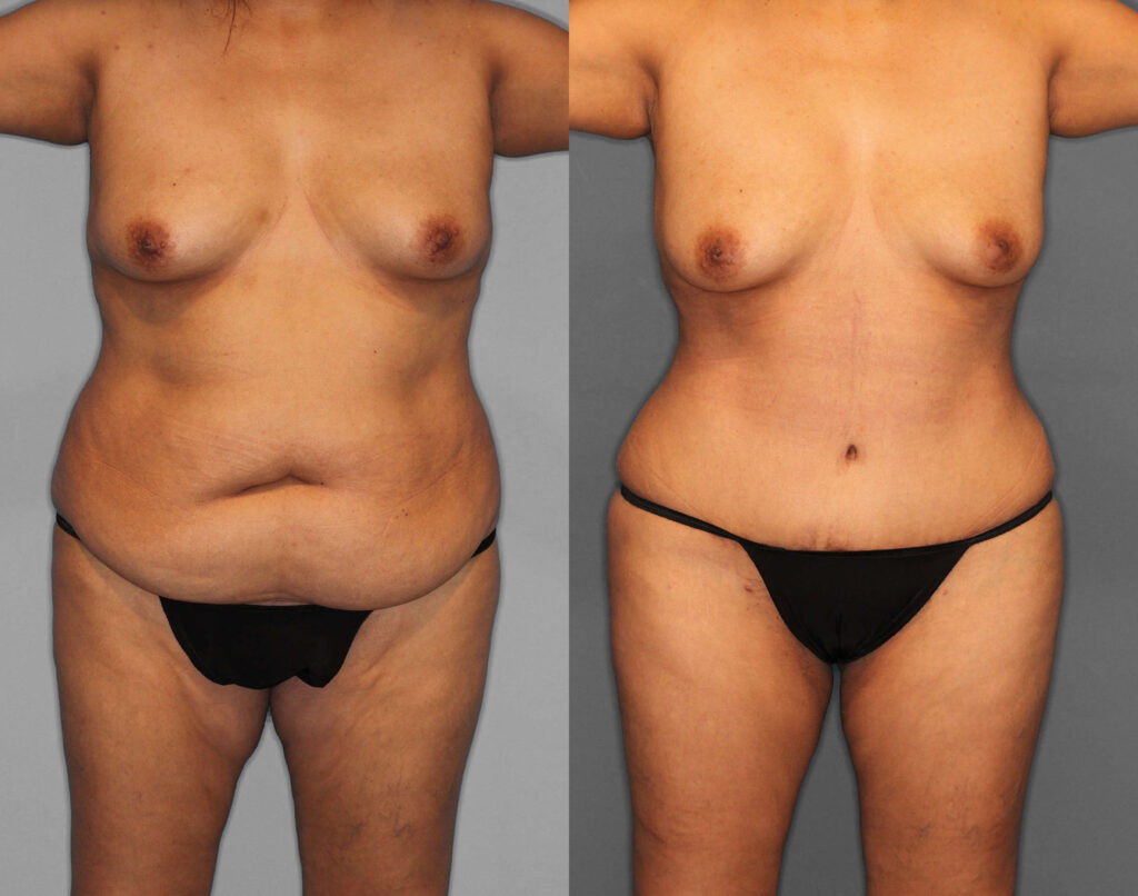 Tummy Tuck:Liposuction:BBL Before and After photo by Dr. Abigail Rodriguez in Houston, TX
