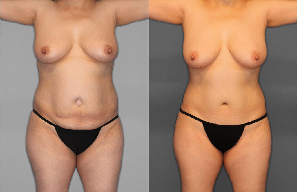 Tummy Tuck:Liposuction:Hernia Before and After photo by Dr. Abigail Rodriguez in Houston, TX