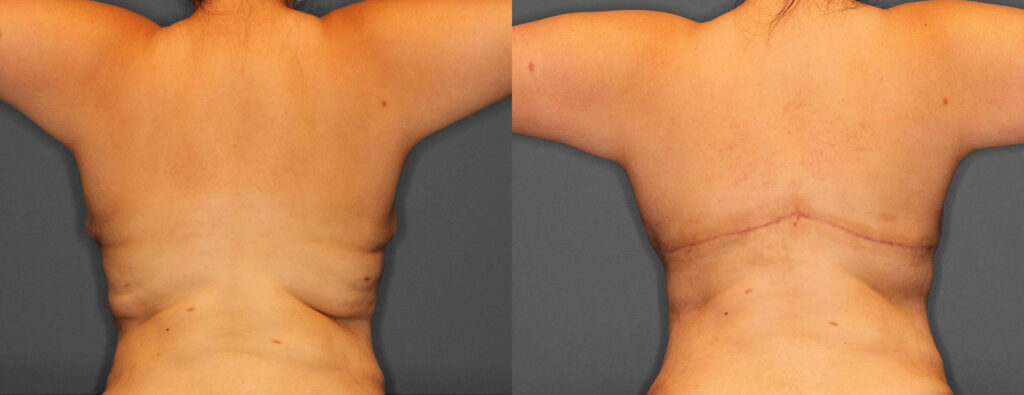 Bra Line Lift Before and After photo by Dr. Abigail Rodriguez in Houston, TX