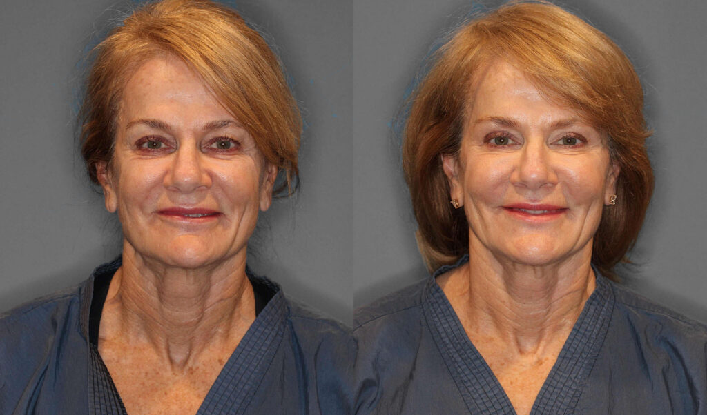 Eyelid Lift:Facial Fat Grafting Before and After photo by Dr. Abigail Rodriguez in Houston, TX