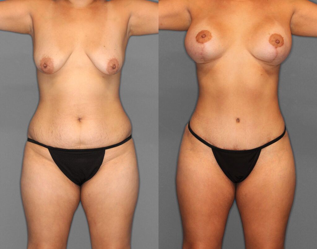 Tummy Tuck Before and After photo by Dr. Abigail Rodriguez in Houston, TX