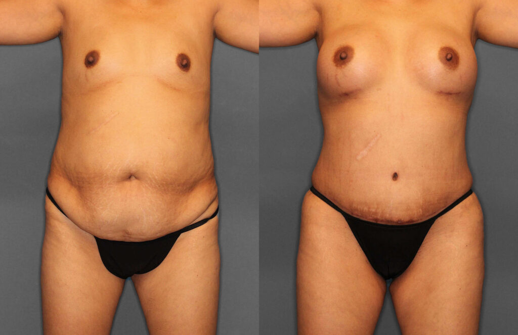Tummy Tuck:Liposuction Before and After photo by Dr. Abigail Rodriguez in Houston, TX