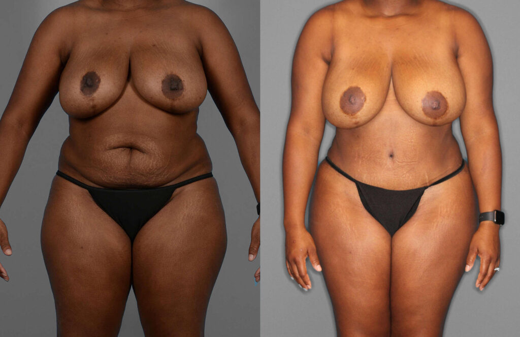 Fat Grafting:Liposuction:Tummy Tuck Before and After photo by Dr. Abigail Rodriguez in Houston, TX