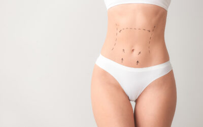 3 formas inteligentes de pagar una abdominoplastia en Houston, TX