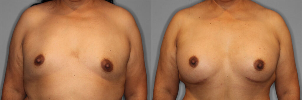 Breast Augmentation Before and After photo by Dr. Abigail Rodriguez in Houston, TX 158735