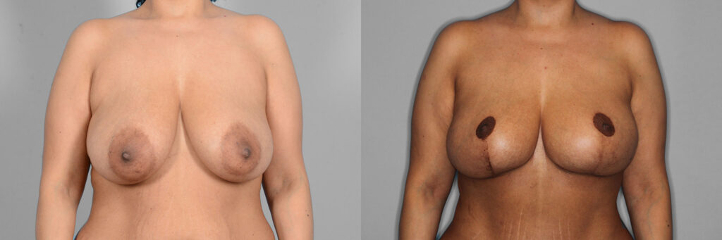 Breast Lift + Augmentation Before and After photo by Dr. Abigail Rodriguez in Houston, TX