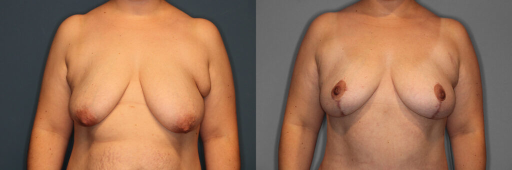 Breast Lift Before and After photo by Dr. Abigail Rodriguez in Houston, TX