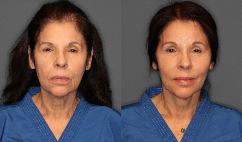 Face Neck Lift, Eyelid & Brow Lift Before and After photo by Dr. Abigail Rodriguez in Houston, TX