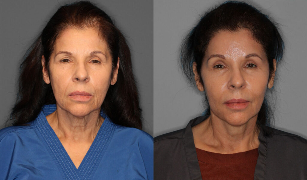 Face/Neck Lift, Upper Eyelid, Brow Lift Before and After photo by Dr. Abigail Rodriguez in Houston, TX
