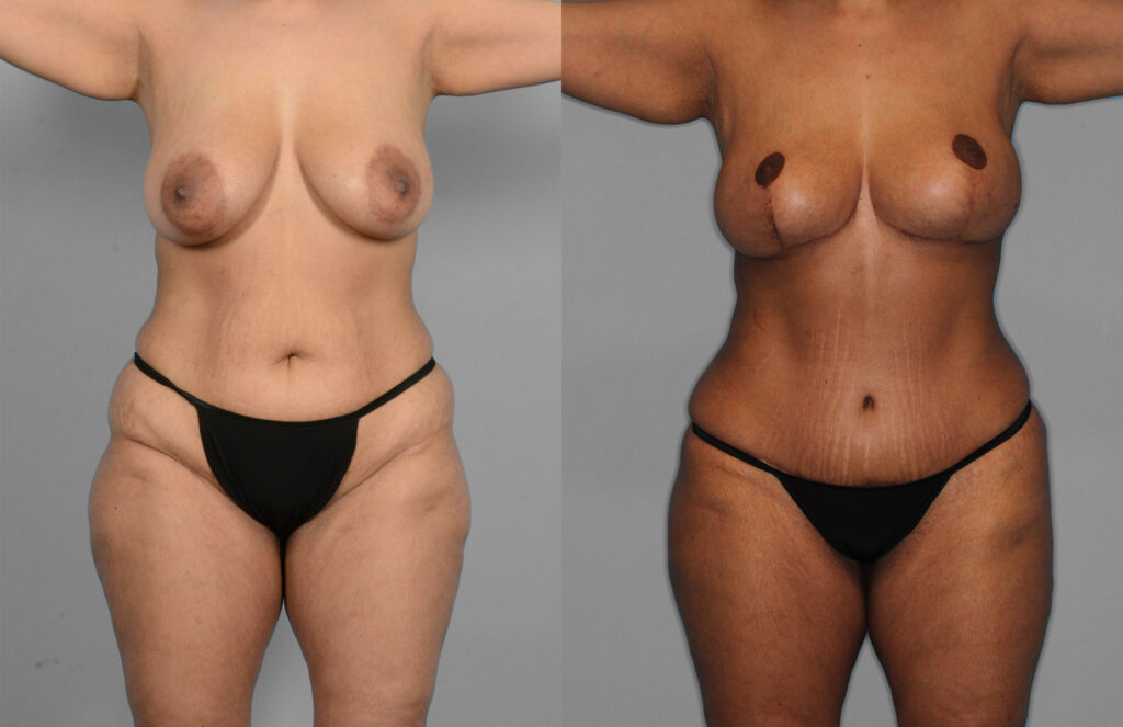 Tummy Tuck Before and After photo by Dr. Abigail Rodriguez in Houston, TX