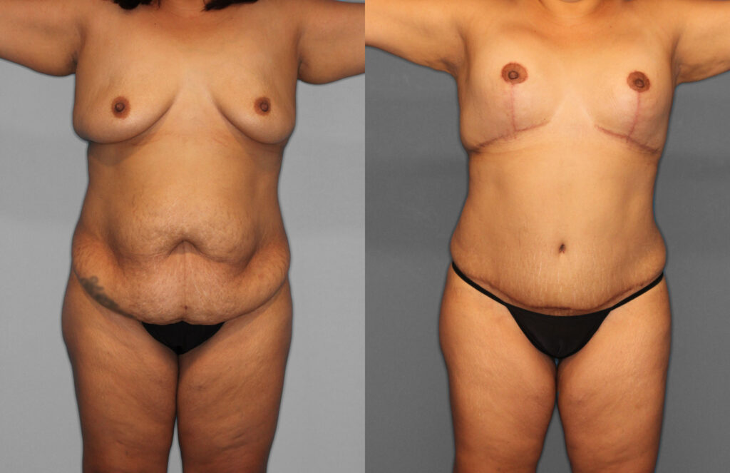 Tummy Tuck Before and After photo by Dr. Abigail Rodriguez in Houston, TX
