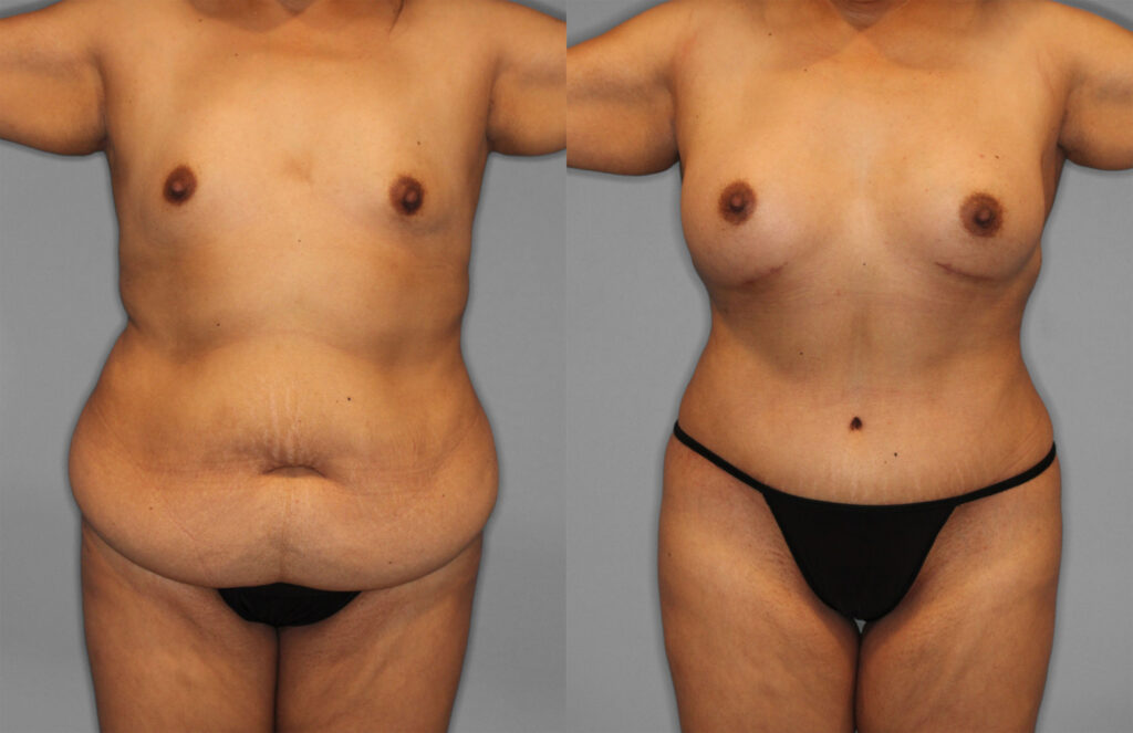 Tummy Tuck Before and After photo by Dr. Abigail Rodriguez in Houston, TX