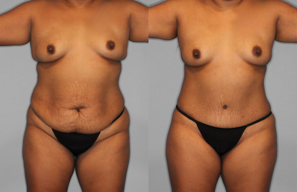 Tummy Tuck Before and After photo by Dr. Abigail Rodriguez in Houston, TX