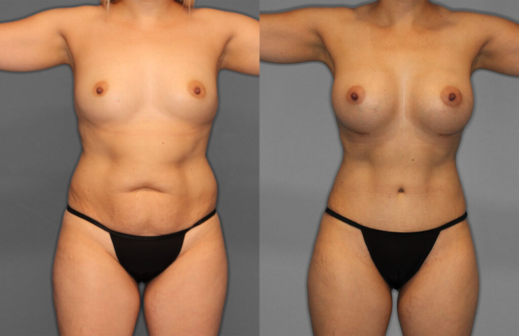 Tummy Tuck Before and After photo by Dr. Abigail Rodriguez in Houston, TX