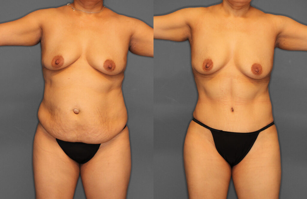 Tummy Tuck Before and After photo by Dr. Abigail Rodriguez in Houston, TX