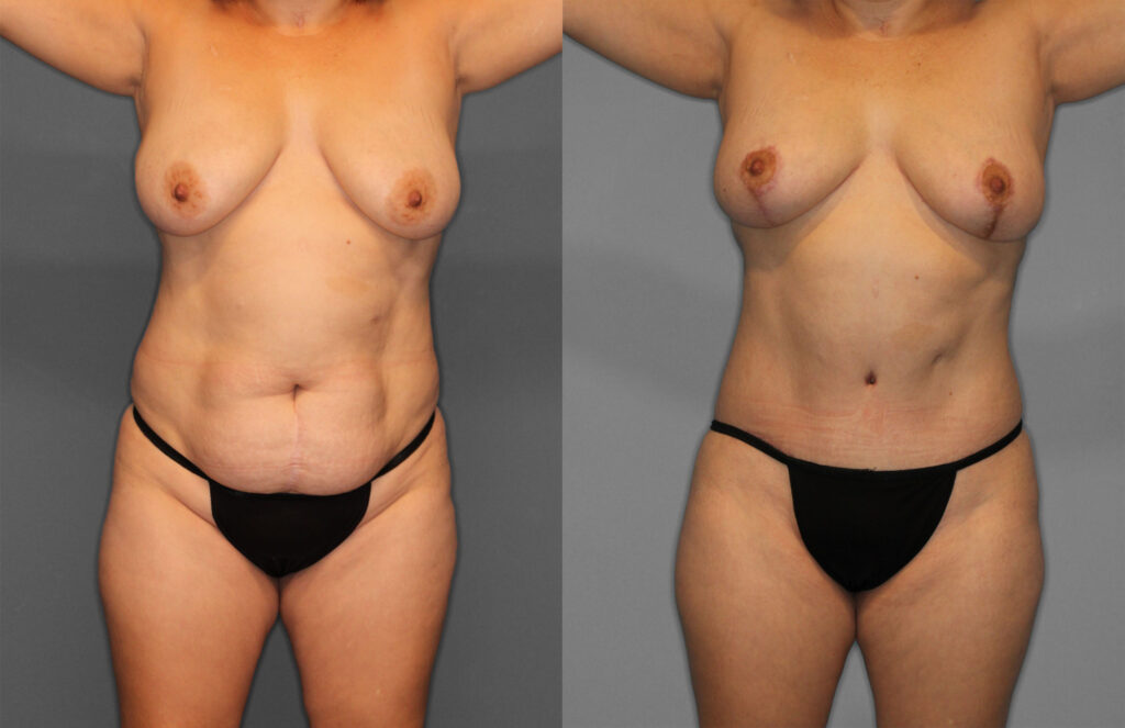 Tummy Tuck Before and After photo by Dr. Abigail Rodriguez in Houston, TX
