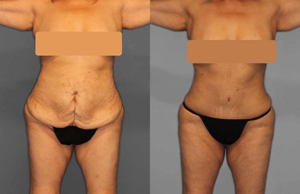 Tummy Tuck Before and After photo by Dr. Abigail Rodriguez in Houston, TX