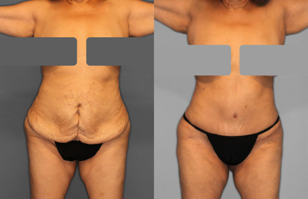 Tummy Tuck Before and After photo by Dr. Abigail Rodriguez in Houston, TX